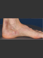 After Photo Treatment of Pigmented Lesion on Foot - Prejuvenation Before & After