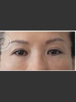 After Photo Undereye Filler - Prejuvenation Before & After