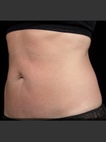 After Photo SculpSure Abdomen - Prejuvenation Before & After
