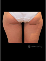 After Photo CoolSculpting Before & After on Woman - Prejuvenation Before & After