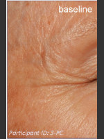 Before Photo DefenAge Clinical Power Trio - Prejuvenation Before & After