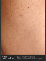 After Photo Tattoo Removal of Skull - Prejuvenation Before & After