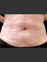 Before Photo Body Contouring Treatment #114 - Prejuvenation Before & After