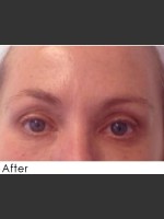After Photo Undereye Filler + Exilis Elite Radiofrequency - Prejuvenation Before & After