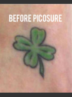 Before Photo Treatment of Tattoo with Picosure - Prejuvenation Before & After