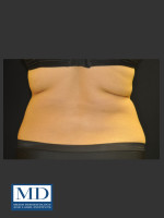 Before Photo  Body Contouring Treatment 141 - Prejuvenation Before & After