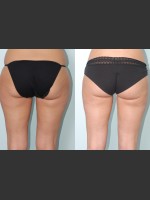 Before Photo Liposuction of waist, hips, thighs, and tummy. - Prejuvenation Before & After