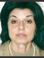 Before Photo Rhytidectomy (Facelift) 1884 - Prejuvenation Before & After