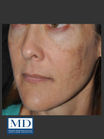 Before Photo Melasma Face Treatment 118 - Prejuvenation Before & After