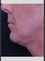 After Photo Profound Contour Treatment of Neck - Prejuvenation Before & After
