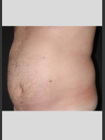 Before Photo UltraShape Body Contouring Abdomen - Prejuvenation Before & After