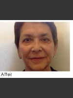 After Photo Radiesse and Restylane Filler Treatment - Prejuvenation Before & After