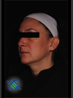 After Photo Treatment of Facial Melasma - Prejuvenation Before & After