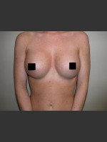 After Photo Breast Augmentation - Prejuvenation Before & After