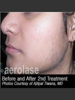 Before Photo Hair Removal #310 - Prejuvenation Before & After