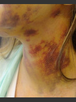 Before Photo Treatment of Neck Brusing - Prejuvenation Before & After