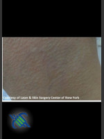 After Photo Treatment of Lower Back Tattoo - Prejuvenation Before & After