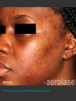Before Photo NeoClear by Aerolase Acne Treatment - Prejuvenation Before & After