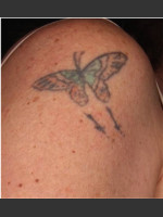 Before Photo Treatment of Shoulder Tattoo - Prejuvenation Before & After
