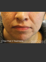 After Photo NeoClear by Aerolase Acne Treatment - Prejuvenation Before & After