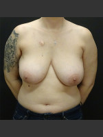 Before Photo Breast Reconstruction Case #1 - Prejuvenation Before & After