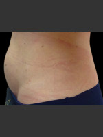 After Photo Body Contouring Treatment #117 - Prejuvenation Before & After