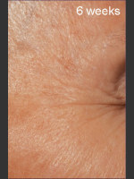After Photo DefenAge Clinical Power Trio - Prejuvenation Before & After