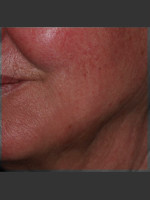 After Photo Infini Rhytides Treatment #19 - Prejuvenation Before & After