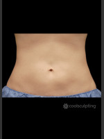 After Photo CoolSculpting on Woman's Stomach - Prejuvenation Before & After