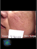 Before Photo Treatment of Facial  Acne Scars Left Side - Prejuvenation Before & After