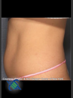 After Photo CoolSculpting Treatment of Lower Abdomen Side On - Prejuvenation Before & After