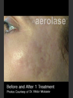 After Photo Treatment of Acne Scars #308 - Prejuvenation Before & After