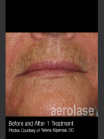 Before Photo Treatment of Melasma #317 - Prejuvenation Before & After