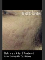 Before Photo Treatment of Acne Scars #308 - Prejuvenation Before & After