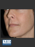 After Photo Melasma Face Treatment 118 - Prejuvenation Before & After