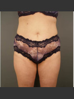 After Photo Liposuction #44 Front View - Prejuvenation Before & After