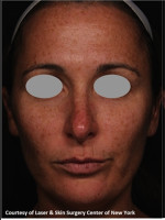 Before Photo Full face Treament with Fraxel - Prejuvenation Before & After