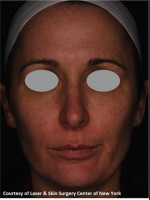 After Photo Treatment of Facial Pigmentation - Prejuvenation Before & After