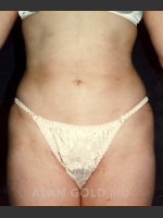 After Photo Liposuction 439 - Prejuvenation Before & After