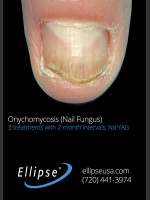 After Photo Treatment of Toe Nail Fungus - Prejuvenation Before & After