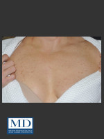 Before Photo IPL Brown Spots Treatment 108 - Prejuvenation Before & After