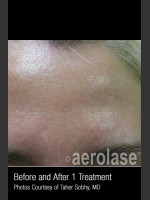 After Photo Treatment of Pores and Skin Texture #338 - Prejuvenation Before & After