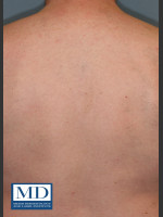After Photo Laser Hair Removal 122 - Prejuvenation Before & After
