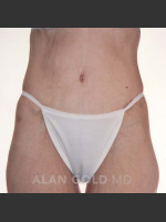 After Photo Circumferential Body Lift 367 - Prejuvenation Before & After