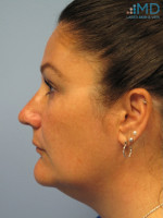 After Photo Exilis Skin Tightening - Prejuvenation Before & After