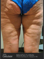 Before Photo Cellulaze Cellulite Treatment - Prejuvenation Before & After