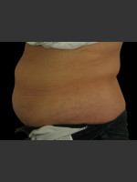 After Photo Body Contouring Treatment #121 - Prejuvenation Before & After