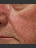Before Photo Dr. Langdon IPL Treatment  - Prejuvenation Before & After