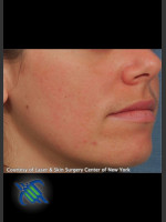 After Photo Facial Acne Scaring Treatment - Right Side  - Prejuvenation Before & After