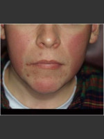 Before Photo Rosacea treated by laser. - Prejuvenation Before & After